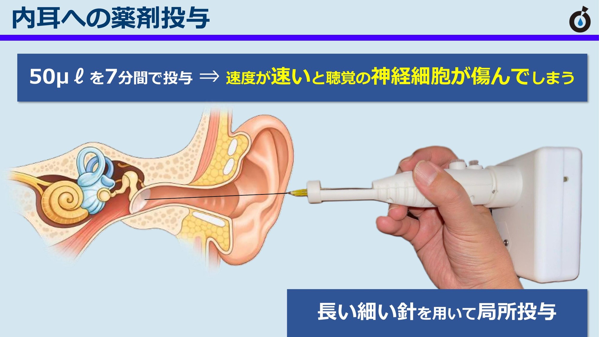 内耳への薬剤投与のイメージ（神崎先生コメント参照）